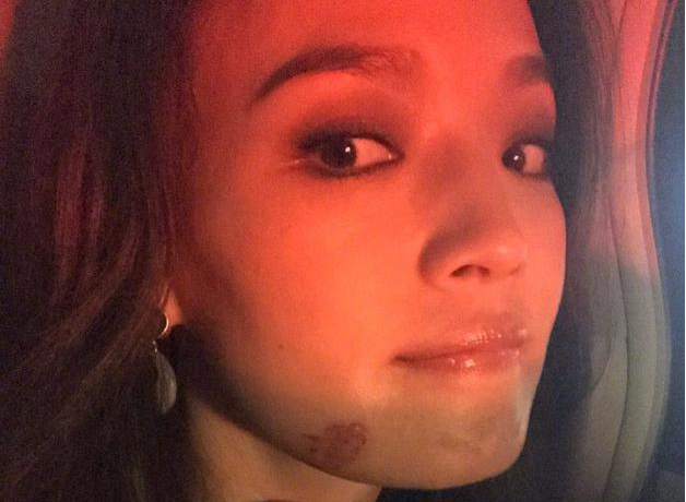 舒淇不小心撞伤了脸颊仍坚持工作